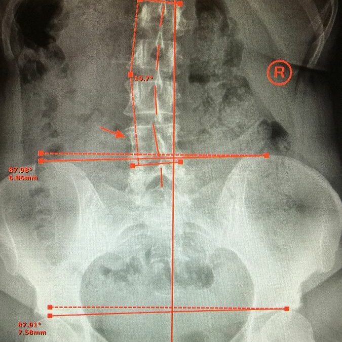 The Key to Scoliosis Correction