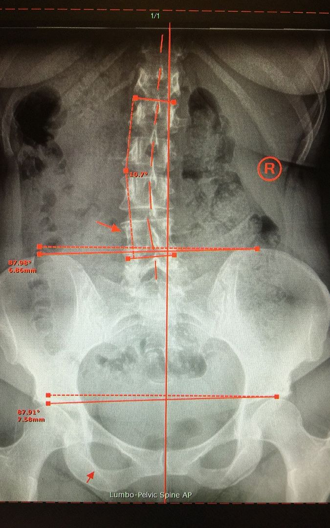 Scoliosis Corrections Image at Madeira Chiropractic in Hershey, PA